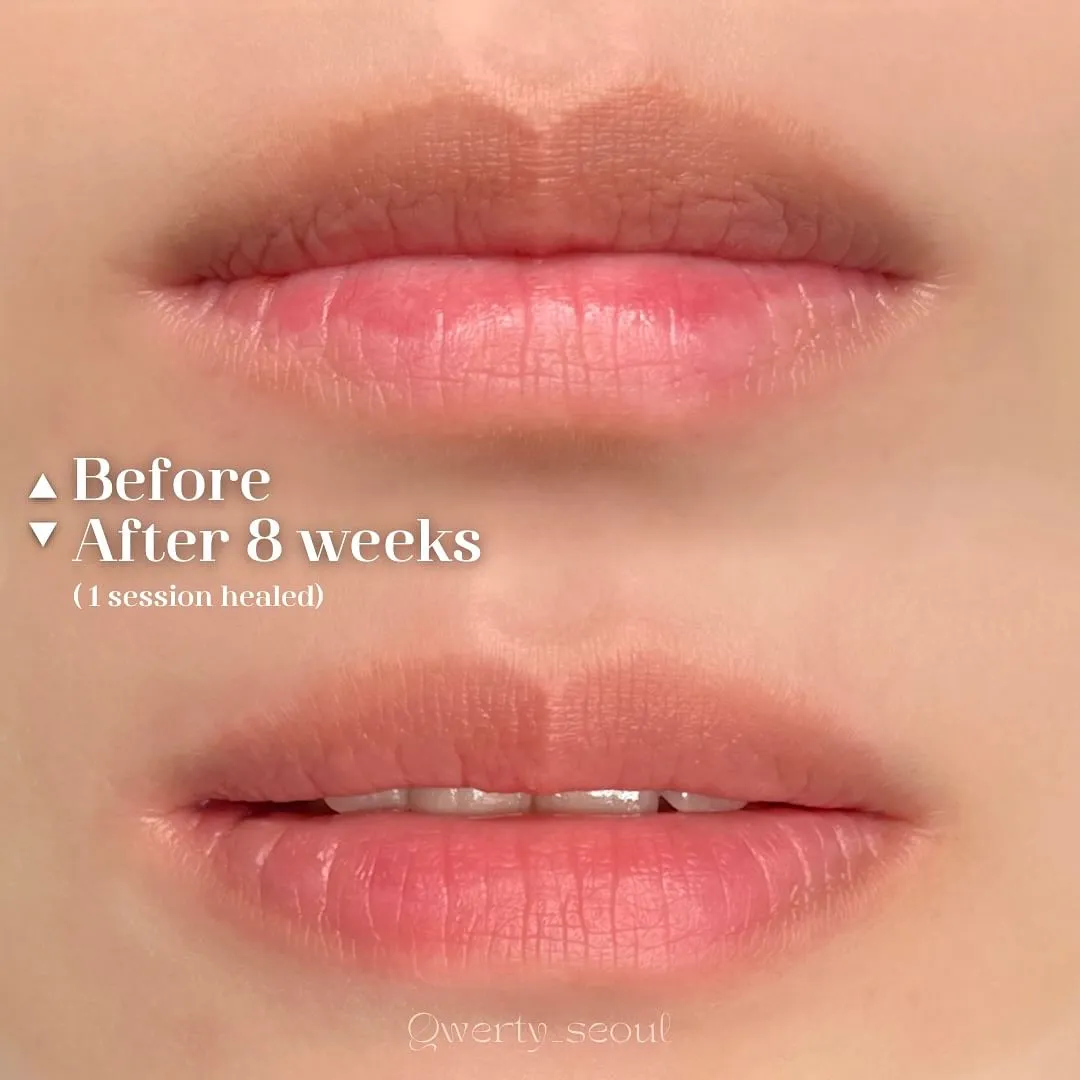 ๋ฌดํต์ฆ ์บ๋๋ฆฝ